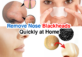 8 Best Tips of How To Remove Nose Blackheads Quickly at Home