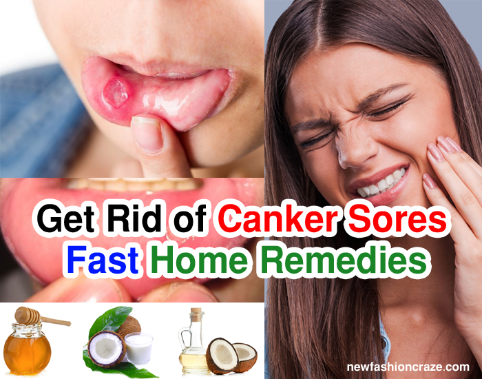 How to Get Rid of Canker Sores Fast Home Remedies