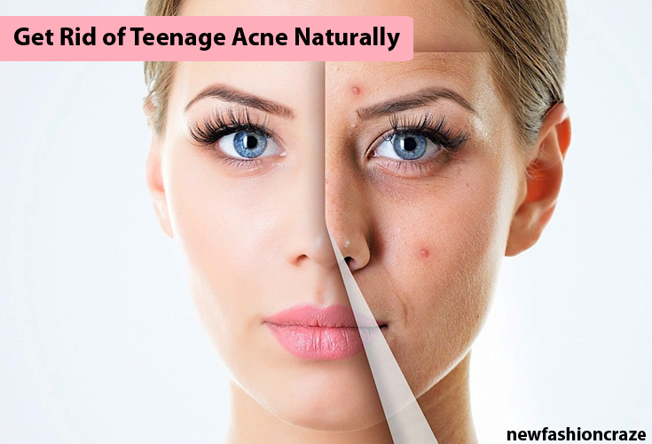 How to Get Rid of Teenage Acne Naturally