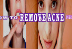 How To Remove Acne Overnight Fast – Home Remedies