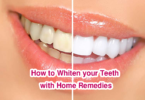 How to Whiten your Teeth with Home Remedies