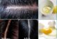How to Get Rid of Dandruff – 5 Unique Ideas
