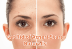 we will present various natural home remedies that can help treat acne scars. 13 Home Remedies - How to Get Rid of Acne Scars Naturally 2023/ 2024.