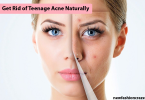 We will share 5 best and easy tips to used and Get Rid of Teenage Acne Naturally at home 2023/ 2024. Find the top and best Acne Treatment for Girls.